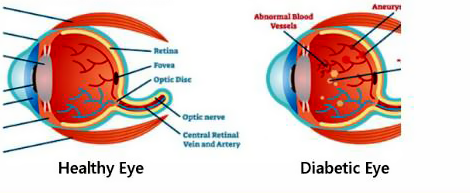 diabetes_affect_ retina